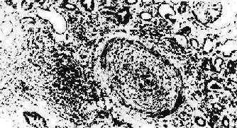 ����ֲ�����ųⷴӦ