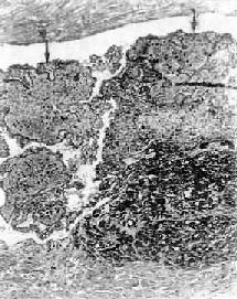 ��ǻ��Ѫ˨�ķŴ���ҪΪ��ɫѪ˨������������Ϊ��ά��