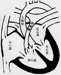 Fallot����֢ģʽͼ