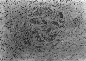 Ѫ���没֮���Գ��ѽ��