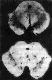 Parkinson��