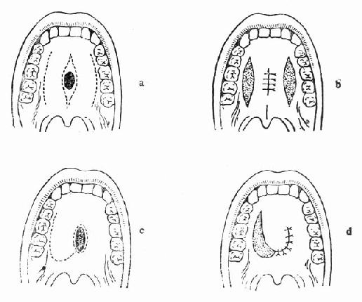 Ӳ����֯ȱ��Ĵ���