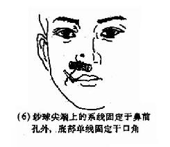 后鼻孔填塞法