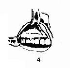 上颌窦根治术 4.切开粘膜，粘膜骨膜一起剥离