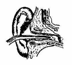 外耳道异物镊取法