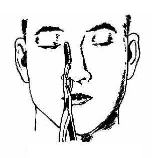 鼻骨复位钳复位法