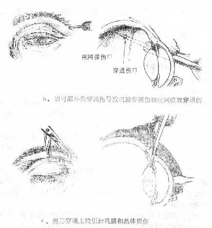 ���򴩿���